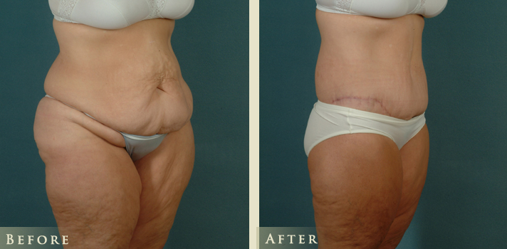 Body Lift Before And After Photo Gallery Los Angeles, CA, 54% OFF