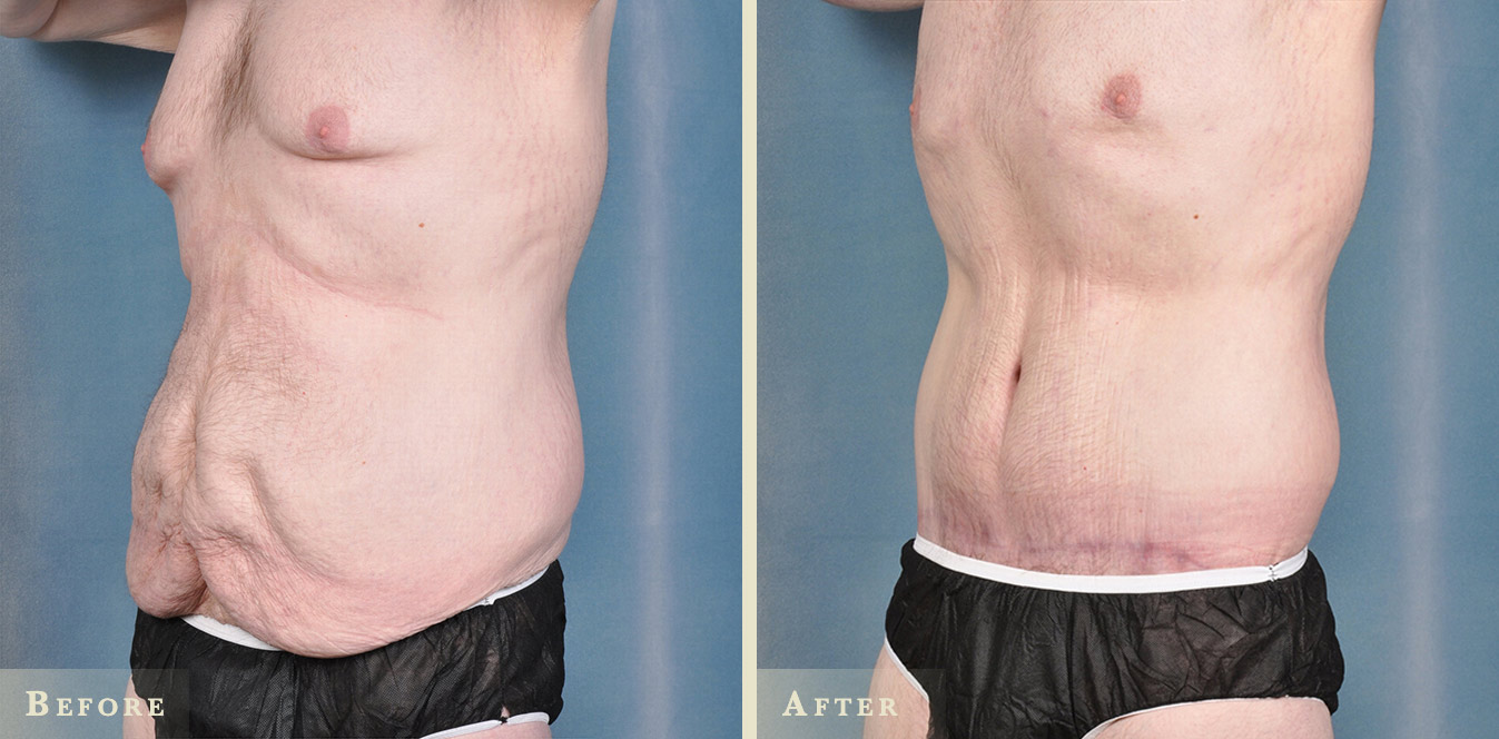 Body Lift or Lower Body Lift - American Society of Bariatric Plastic  Surgeons (ASBPS)