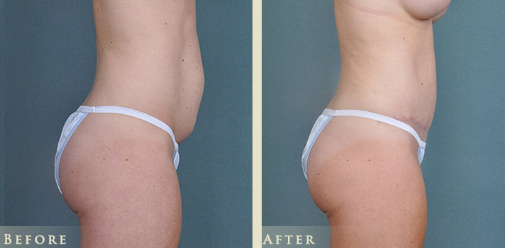 Tummy Tuck Before and After | Colorado Plastic Surgery