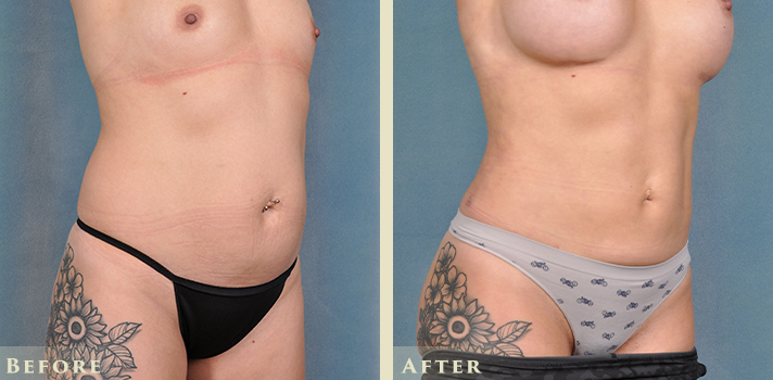 Tummy Tuck Before and After | Colorado Plastic Surgery