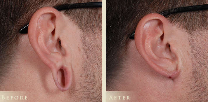 Ear Lobe Repair Before and After Pictures Case 174