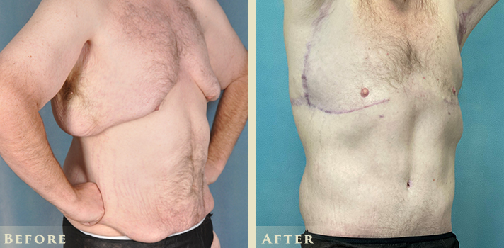 40% of Breast Reduction Surgeries Are Performed on Men