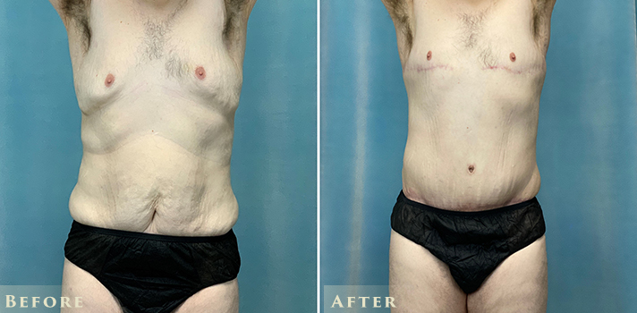 Male Liposuction Before and After