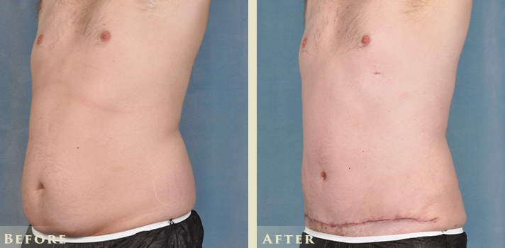 Tummytuck Before and After | Colorado Plastic Surgery